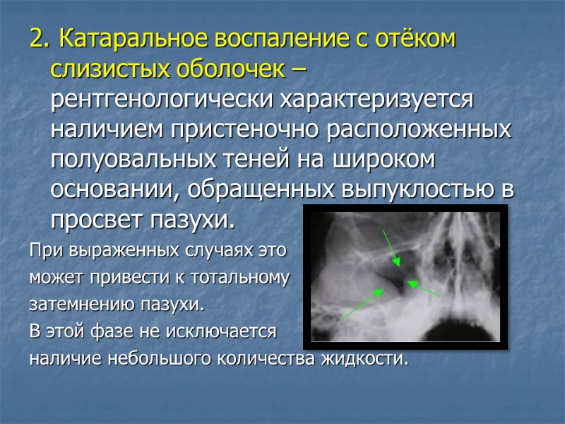 2. Катаральное воспаление с отёком слизистых оболочек – рентгенологически характеризуется наличием пристеночно расположенных полуовальных